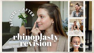 My Rhinoplasty Revision Experience: Before + After, Recovery, Cost + Hospital Stay