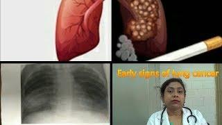 5 early signs of lung cancer|hindi