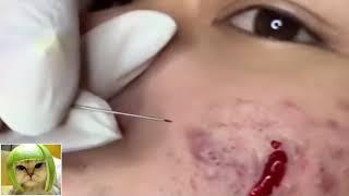 Removes acne | Давим прыщи | чёрные точки | Залипательно 2021