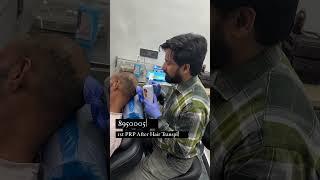 1st PRP Therapy After Hair Transplant |Hair transformation #shorts #viral #trending #gfc #hair #prp