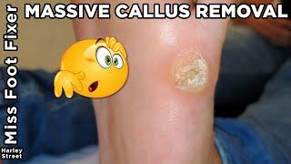 WOW, massive callus removal with gouge By Miss Foot Fixer Marion Yau