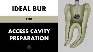 Ideal bur for Access Cavity Preparation