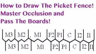 Occlusion - Picket Fence - NBDE Part 1 Boards Study