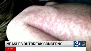 Measles outbreak concern