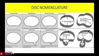 Lecture Imaging the degenerative lumbar spine   Gurudip Das