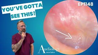 Satisfying Ear Wax Removals! Deep Wax Plugs & Skin Peels | Microsuction Compilation   EP1048