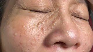 Make your Acne Treatment Huong Da Nang#502 | acne 2022 PArt 1