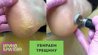 Deep CRACK ON THE HEEL  Pedicure  Irina Brilyova