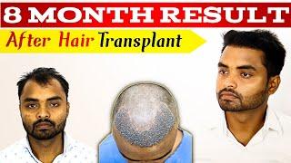 Best Hair Transplant  Result After 8 Month || 8 Month Result After Hair Transplant.