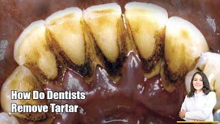 4 Years Without Brushing Teeth | Tartar Removal EXTREME CALCULUS REMOVAL FEMALE, 42y  Worst Tartar