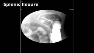 Barium Enema Double Contrast Fluoro --- Step by Step Instructions