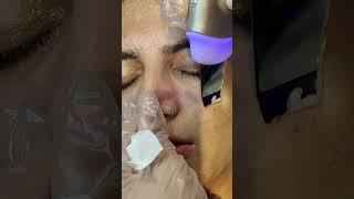 What does a Hydra facial do? - Hydrafacial Step By Step Procedure