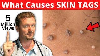 What SKIN TAGS Really Mean  (What Causes Skin Tags?)