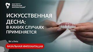 Искусственная десна в стоматологии — зачем и для чего? Базальная имплантация и восстановление зубов.