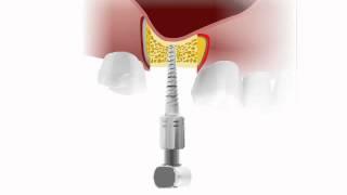 Bone Compression Kit - MIS Implants