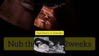 Gender prediction #nub theory #ultrasound #pregnancy #shorts