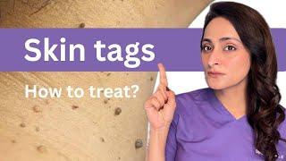 Why do skin tags form? How to treat ? Dermatologist suggests