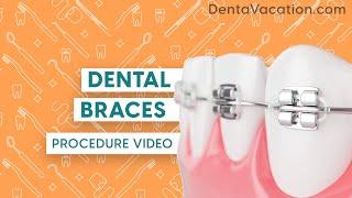 Dental Braces Abroad | DentaVacation