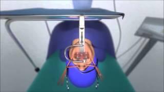 COBLATION◊ Tonsillectomy and Adenoidectomy Animation