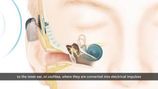 How the Cochlear™ Baha® Attract System Works