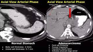 CT Scan Normal Stomach Vs Gastric Adenocarcinoma Images | Early & Advanced Stage Cancer Cases