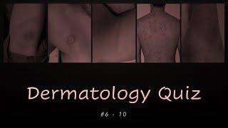 Dermatology Quiz #6 - 10