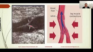 Varicose Anatomy and  Pathophysiology by Dr.Kareem A.Abdelaziz..Part (1/2)