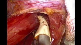 lap fundoplication by prof. Wael Tobar