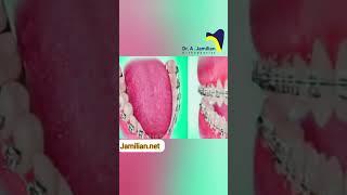 Effective Tooth Brushing Techniques for Orthodontic Patients #dentist #orthodontics