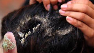 Dry Flaky Scalp Removal At Home - Dandruff Scratching Satisfying