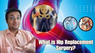 What is Hip Replacement Surgery? #orthosis #orthocentre #doctor