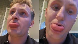 Man's Tongue Swells After Swallowing a Bee