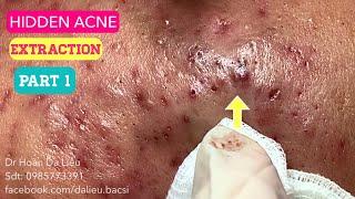 Nặn mụn ẩn đầy mặt |Big acnes pimples,pusstule,blackheads, anti acne, whiteheads removed 0985773391