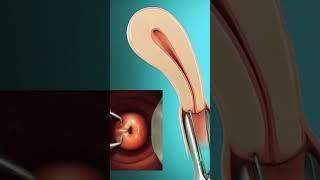 IUD insertion | How to prevent pregnancy | IUD procedure | Pregnancy kaise roke | Dr NeerajPahlajani