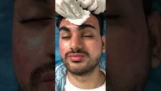 Best Carbon Laser Facial at Skinaa Clinic #skincare  #shorts #hydrafacial