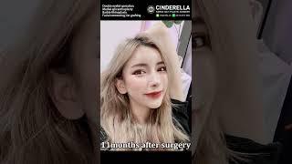 After surgery...she looks like...?! #plasticsurgeryinkorea #beforeandafter #koreanplasticsurgery