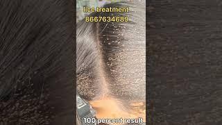 How to remove nits and lice #hair #headliceremoval #eeru #haircare #liceremoval #nits #peenu #lice