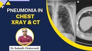 X Ray - CT Chest Type of Diseases LIVE