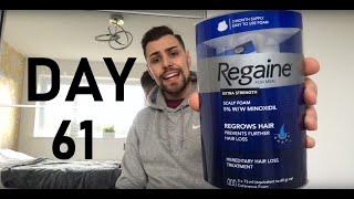 Minoxidil 5% Regaine on Beard: Day 61