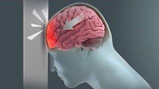 TBI(Traumatic brain injury)  #braininjury  #truamacare #headinjury #headproblem #exercise #bedcare