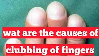 wat is clubbing of fingers|wat are the causes of clubbing of fingers|