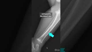 NEJM Images in Clinical Medicine: Toddler’s Fracture