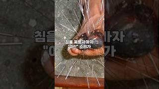 현대의학니 포기한 남자의 발을 한의학이 치료했다..