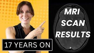 Multiple Sclerosis 17 Years On - MRI Scan Results