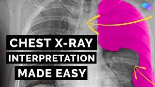 Chest X-ray Interpretation | How to Read a CXR | OSCE Guide | UKMLA | CPSA