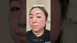 Cosmelan Peel Application and Results | Sun Spots, Acne Scars and Hyperpigmentation