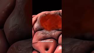 A Ruptured Brain Aneurysm