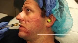 Laser Skin Resurfacing For All Skin Types - Newport Beach, CA