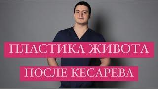 Пластика живота после кесарева Абдоминопластика Диастаз Липосакция Пластика тела Пластический хирург