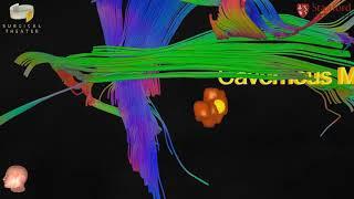 Stanford Neurosurgery Virtual Reality Lab's Anatomy in 3D: Cavernous Malformation